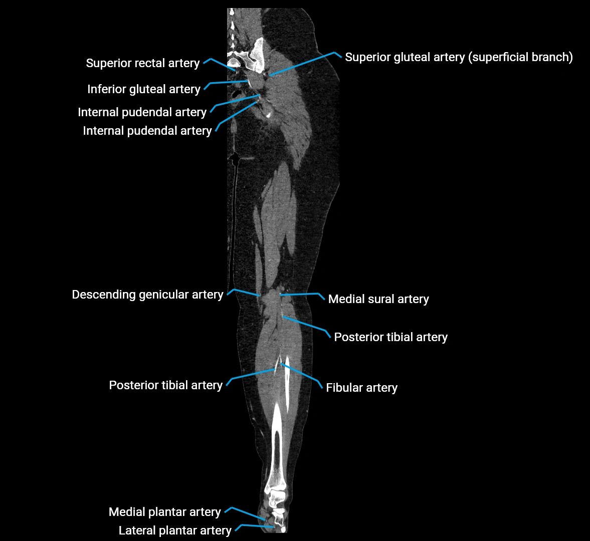 CTA lower limb coronal cross sectional anatomy labelled image _64 (2).webp